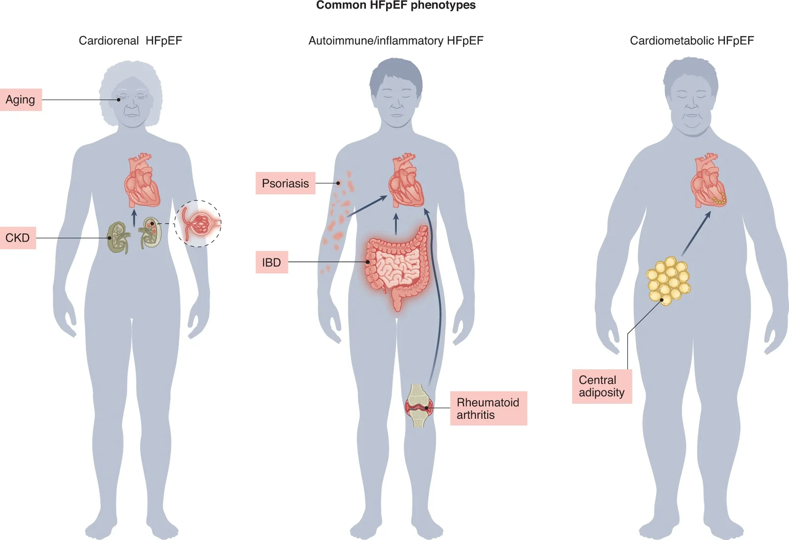 Tres fenotipos de HFpEF: cardiorrenal, autoinmune/inflamatorio y cardiometabólico